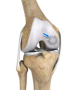 Osteochondral Defect of the Knee