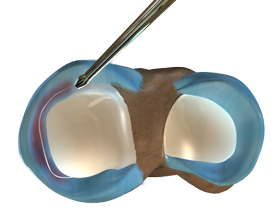 Partial Arthroscopic Meniscectomy