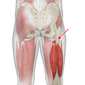 Partial Hamstring Tears