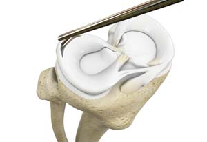  Partial Meniscectomy