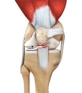 Patellar Tendon Rupture