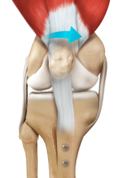 Patellofemoral Stabilization