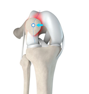 Rehab to Robust - Powering Past Patellofemoral Pain – Part 8 – Why Patellar  'Maltracking' is BS Patellar maltracking, or increased lateral tracking  exists, but the reasons it's commonly attributed to are