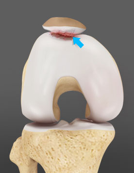 Patellofemoral Arthritis