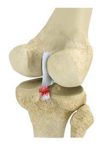 Meniscal Surgery