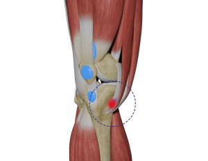 Pes Anserine Bursitis