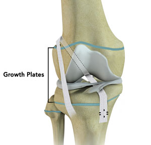 Physeal Sparing Reconstruction of the Anterior Cruciate Ligament