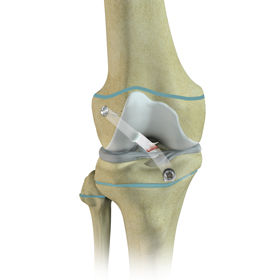 Physeal Sparing Surgery (Anderson's Technique)