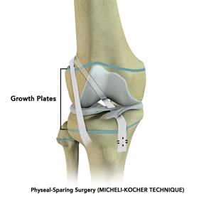 physeal-sparing-surgery-micheli-koc