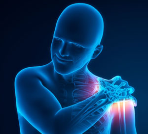 Post-traumatic Stiffness of the Shoulder