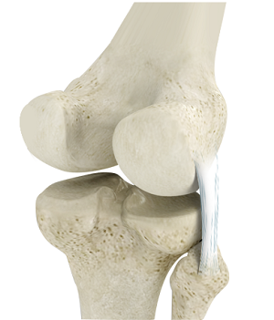 Posterolateral Corner (PLC) Reconstruction