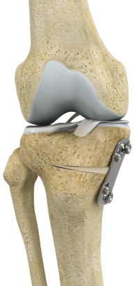 Proximal Tibial Osteotomy