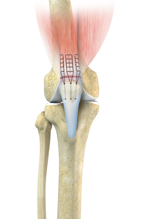 Quadriceps Tendon Repair