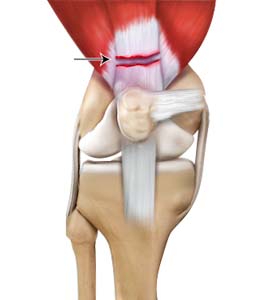 Quadriceps Tendon Rupture and Repair