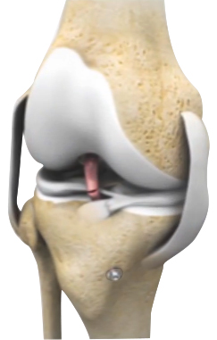 Revision Knee Ligament Reconstruction
