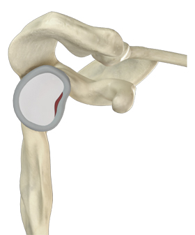 Revision Open Labral Repair (Revision Bankart)