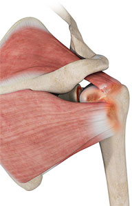 Rotator Cuff Arthropathy