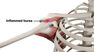 Rotator Cuff Bursitis