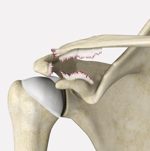 Shoulder Ligament Injuries