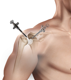 Shoulder Reconstruction Surgery