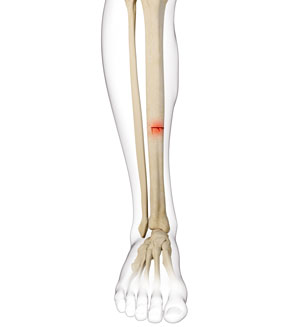 Stress Fracture of the Tibia