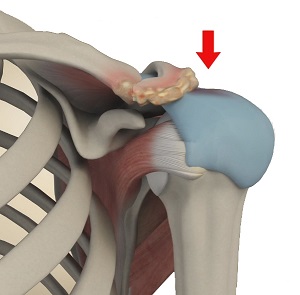 Subacromial Impingement Syndrome
