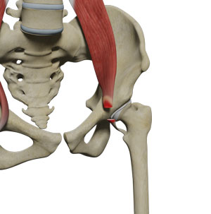 Surgical Release of Iliopsoas Tendon