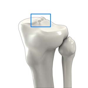 Tibial Eminence Spine Avulsion Fracture