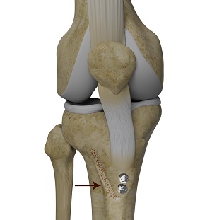 Arthroscopic Debridement