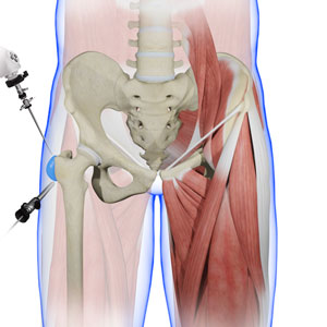 Trochanteric Bursectomy