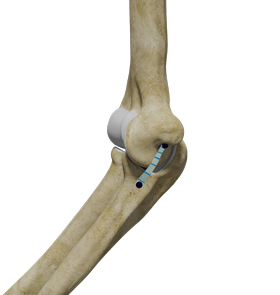 ucl-with-internal-brace